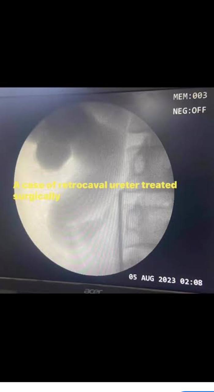 Laparoscopic Nephrectomy